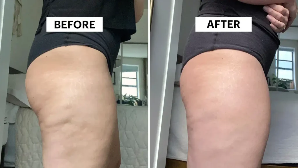 Sculpting Your Bum: Can Toning Exercises Really Reduce Cellulite? 1 Do Toning Exercise Redhill Really Tackle Cellulite?