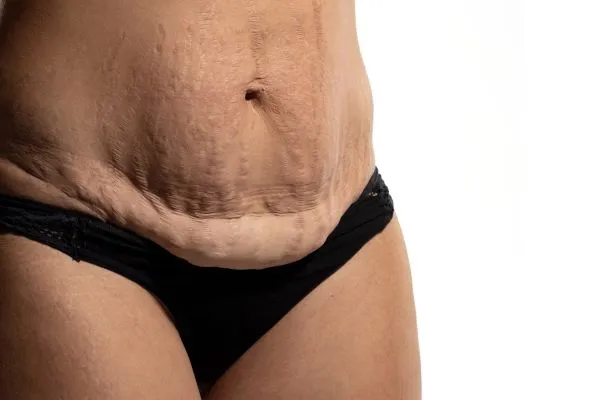The Science of Skin Tightening 1 The science behind skin tightening Redhill picture of a woman's sagging skin on the stomach